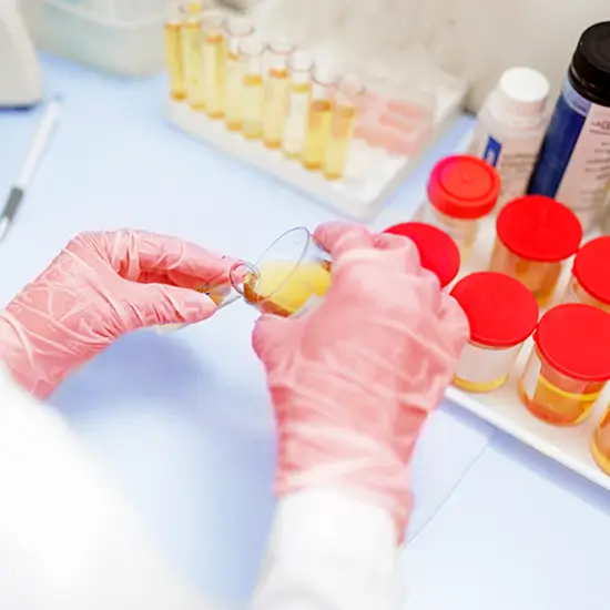 microalbumin creatinine ratio, urine